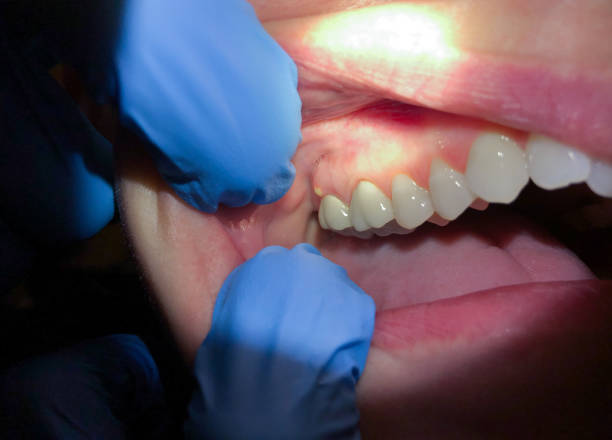 Best Root Canal Emergency Dentist  in Wade, MS